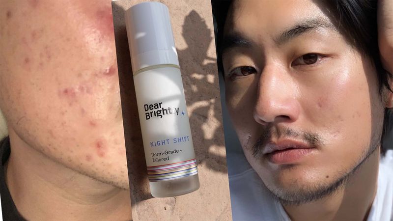 How my skin dramatically changed with tretinoin in five months